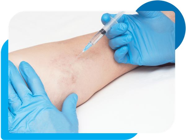 Sclerotherapy